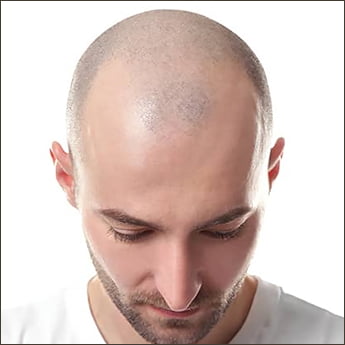 Complete Baldness
