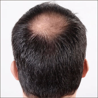 Crown Hair Loss