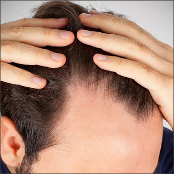 Receded Hairline