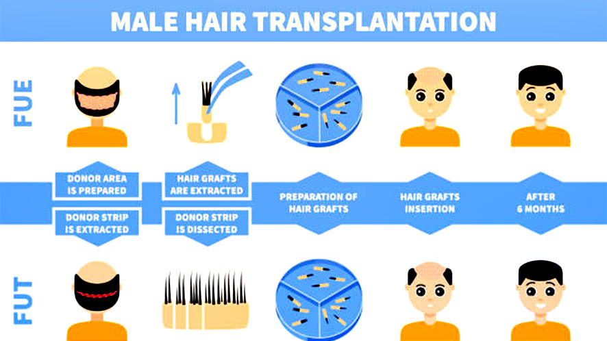 Nonsurgical Hair Replacement System vs Hair Transplant