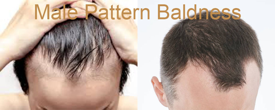 Men Hair Transplant (18)