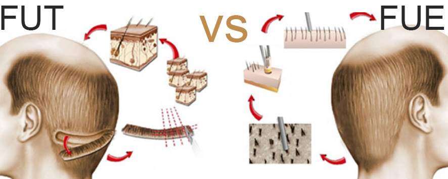 Men Hair Transplant (19)