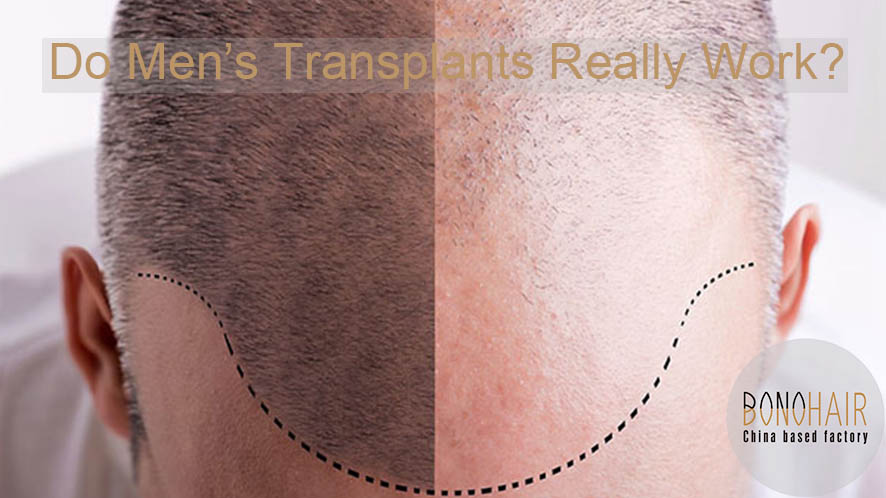 Men Hair Transplant (5)