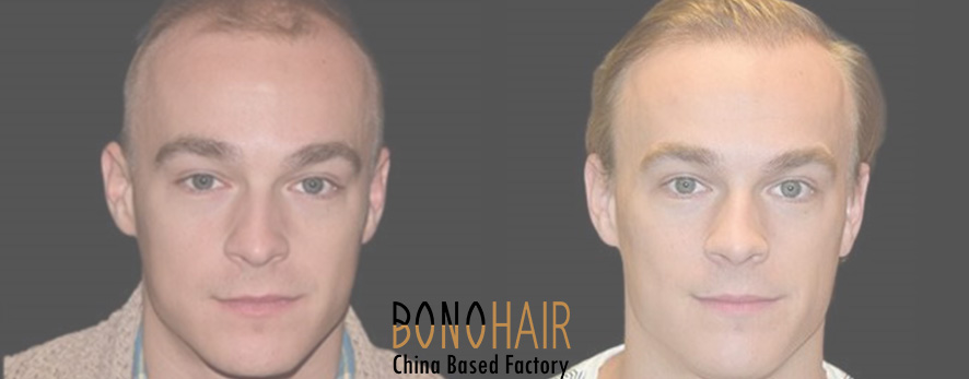 Men Hair Transplant (7)