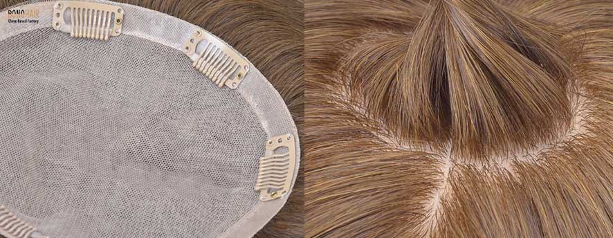 What is Alopecia and Alopecia Treatment (3)